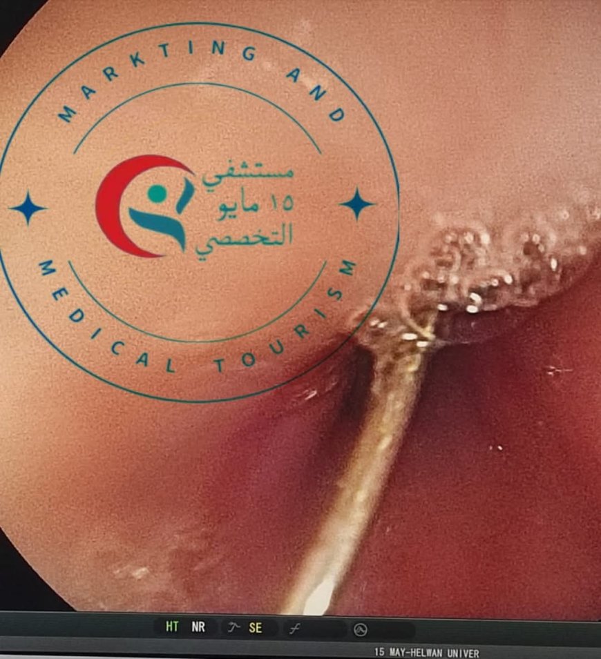 مستشفى ١٥ مايو النموذجي تتصدى المركز الأول بمجهودات فريق الجهاز الهضمي في استخراج جسم معدني من معدة فتاة باستخدام المنظار