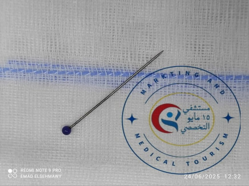 مستشفى ١٥ مايو النموذجي تتصدى المركز الأول بمجهودات فريق الجهاز الهضمي في استخراج جسم معدني من معدة فتاة باستخدام المنظار