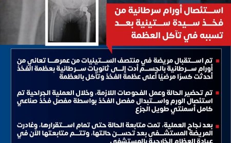 مستشفى ١٥ مايو  النموذجي " تتصدى المركز الأول ديما بمجهودات فريق و جراحات الأورام استئصال أورام سرطانية من فخذ سيدة ستينية بعد تسببه في تأكل العظمة