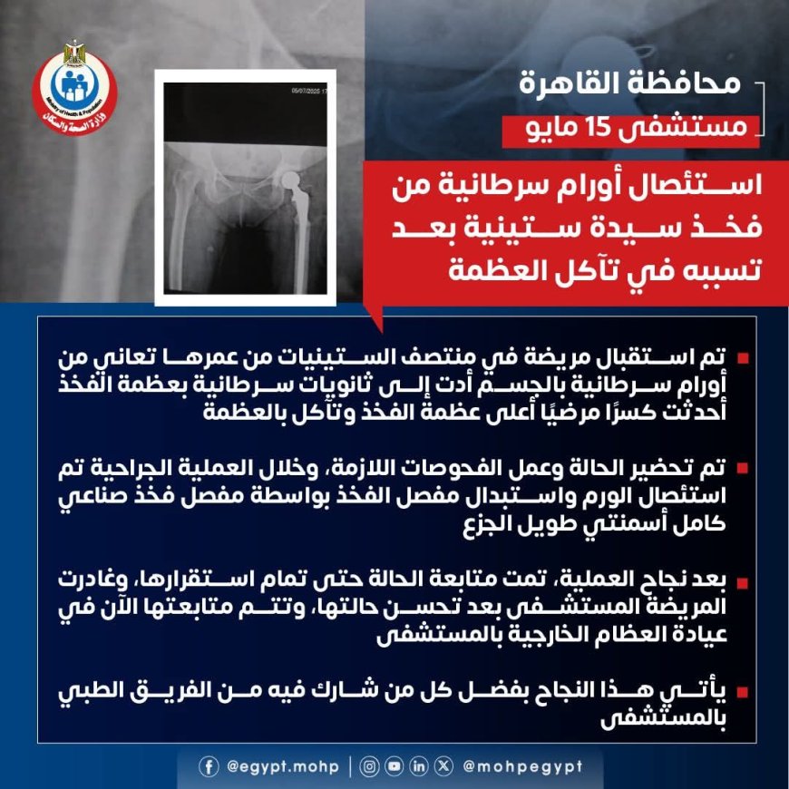 مستشفى ١٥ مايو  النموذجي " تتصدى المركز الأول ديما بمجهودات فريق و جراحات الأورام استئصال أورام سرطانية من فخذ سيدة ستينية بعد تسببه في تأكل العظمة