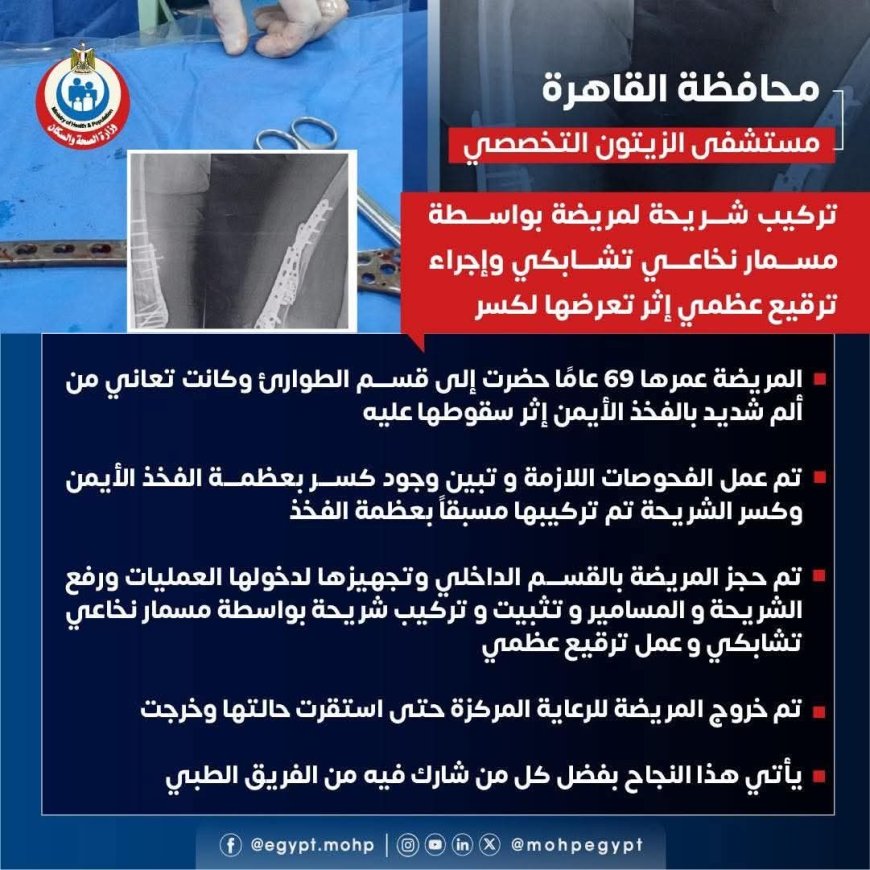 " مستشفى الزيتون التخصصى" نجاح جديد في إجراء تركيب شريحة لمريضة بواسطة مسمار نخاعي تشابكي وإجراء ترقيع عظمي إثر تعرضها لكسر