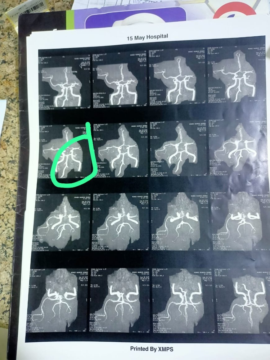 مستشفى ١٥ مايو " نجاح  جديد بوحده السكته الدماغيه لإنقاذ مريض ٤٢ سنة
