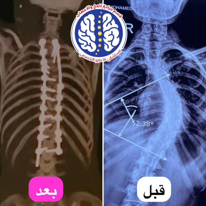 " مستشفى ١٥ مايو " نجاح جديد بمجهودات  إنجاز طبي جديد في جراحة العمود الفقري