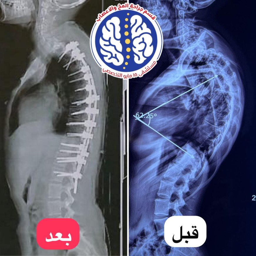 " مستشفى ١٥ مايو " نجاح جديد بمجهودات  إنجاز طبي جديد في جراحة العمود الفقري