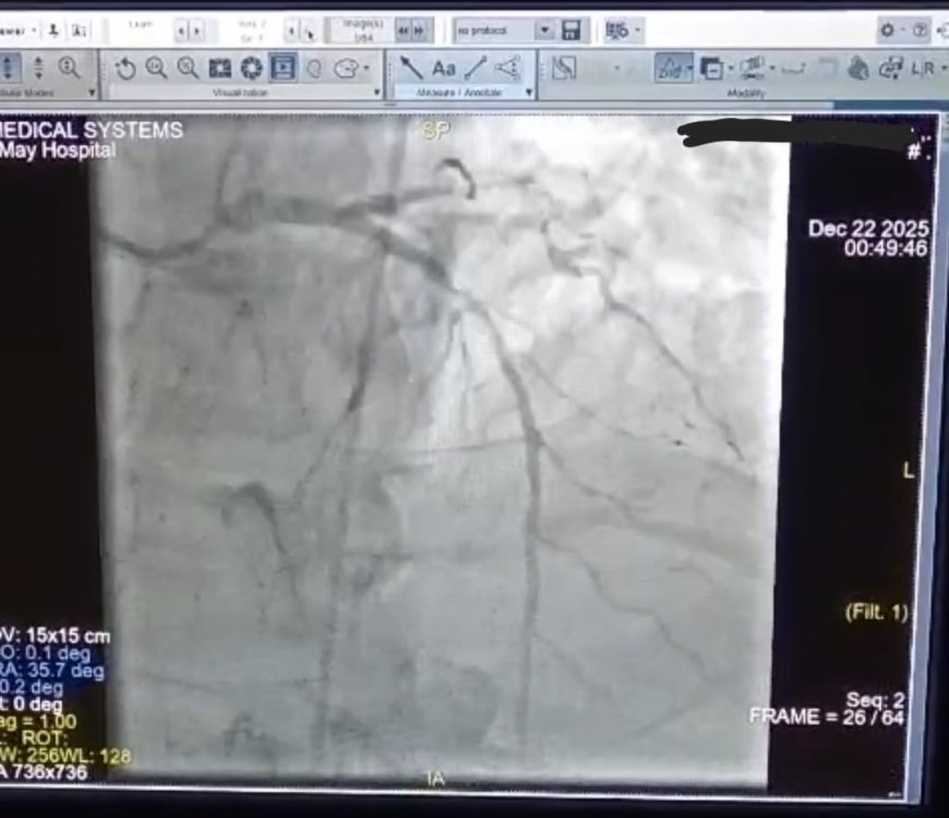 إنقاذ حياة مريض فى حالة حرجه بعد إصابته بجلطة قلبية حادة وتوقف عضلة القلب " مستشفى ١٥ مايو "