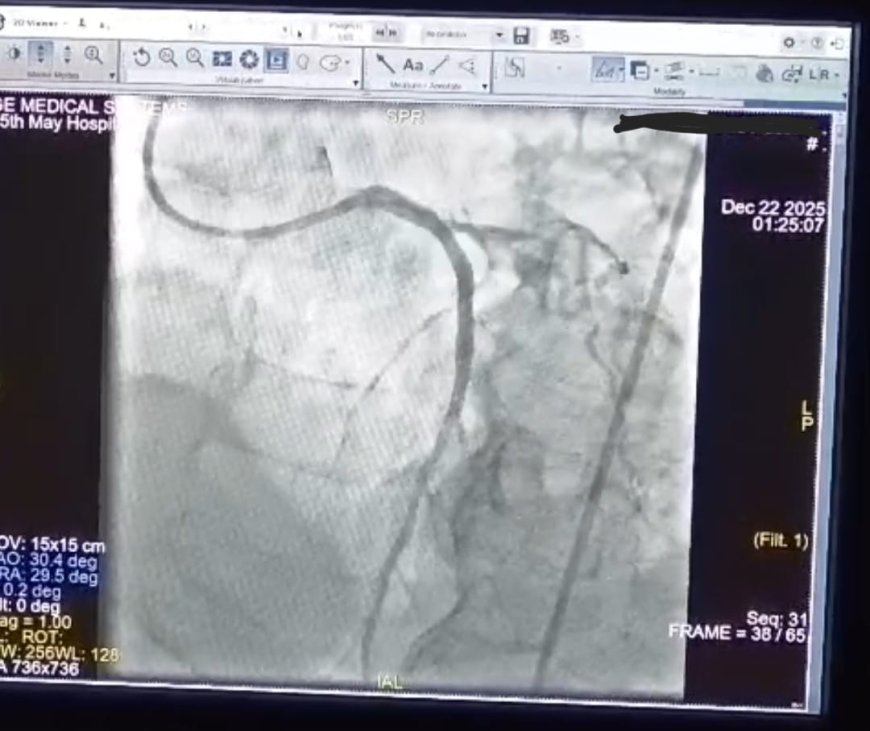 إنقاذ حياة مريض فى حالة حرجه بعد إصابته بجلطة قلبية حادة وتوقف عضلة القلب " مستشفى ١٥ مايو "