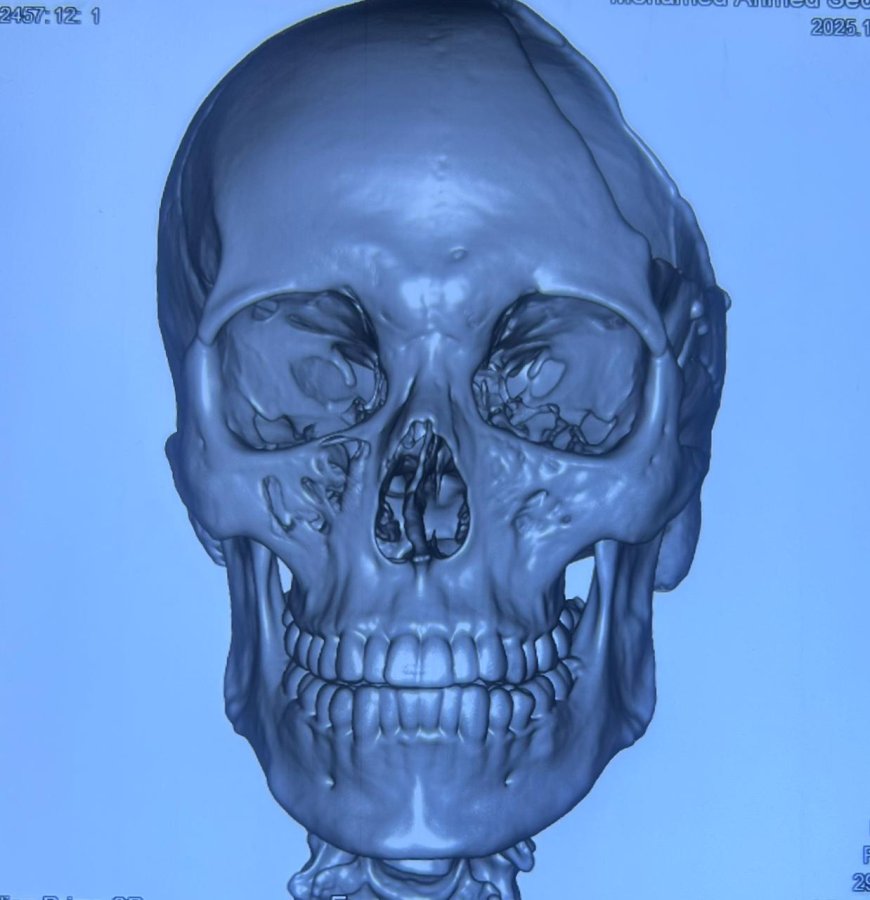 إنجاز طبي جديد بمستشفى 15 مايو.. ترميم جمجمة شاب بتقنية ثلاثية الأبعاد