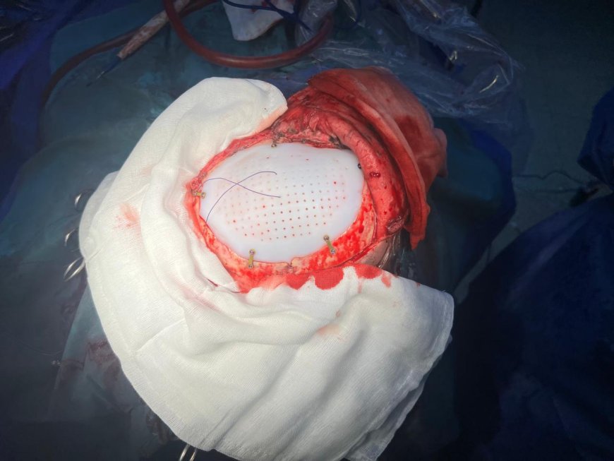 إنجاز طبي جديد بمستشفى 15 مايو.. ترميم جمجمة شاب بتقنية ثلاثية الأبعاد