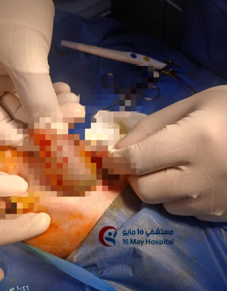 إنجاز طبي جديد بمستشفى 15 مايو التخصصي: إنقاذ مولود حديث يعاني من انسداد كامل بفتحة الشرج