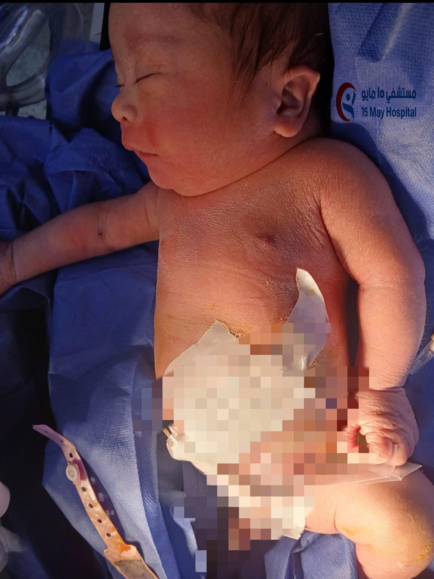 إنجاز طبي جديد بمستشفى 15 مايو التخصصي: إنقاذ مولود حديث يعاني من انسداد كامل بفتحة الشرج