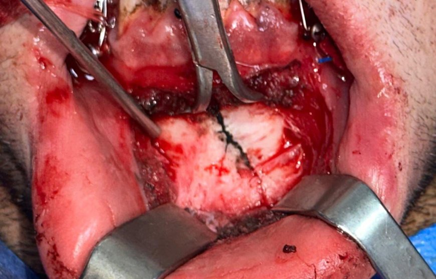 عيادات الأسنان تقدم خدماتها لـ428 مريضًا خلال عيد الفطر المبارك.. ونجاح جراحة وجه وفكين عاجلة بمستشفى عين شمس العام