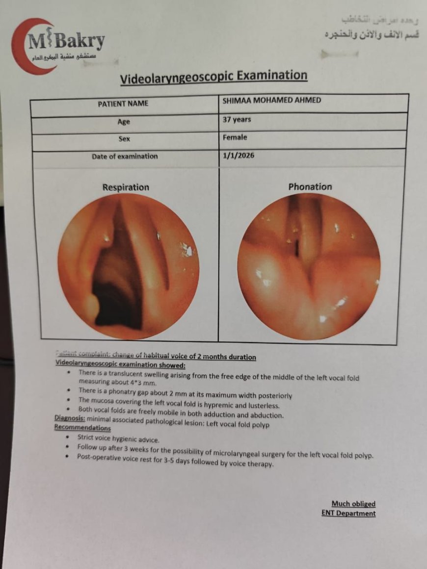 نجاح مستشفى منشية البكري العام في إجراء جراحة دقيقة لاستئصال لحمية بالأحبال الصوتية