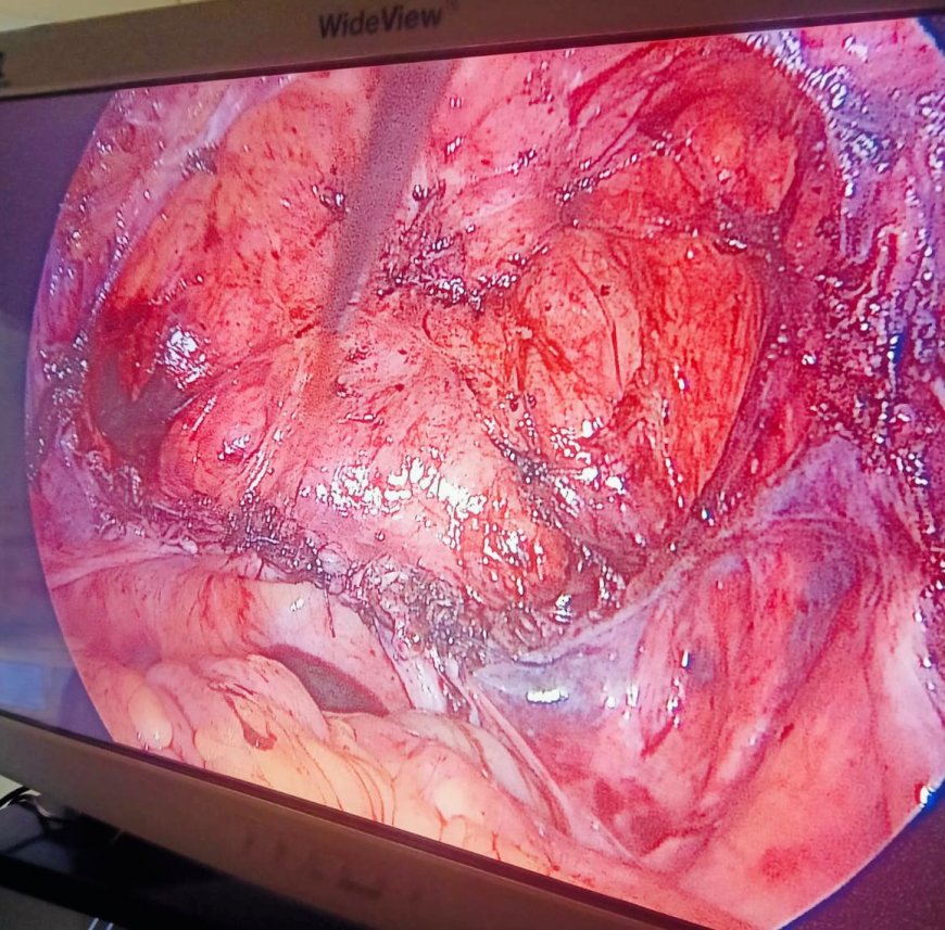 إجراء أول عملية استئصال كامل للرحم بالمنظار الجراحي بمستشفى التبين المركزي