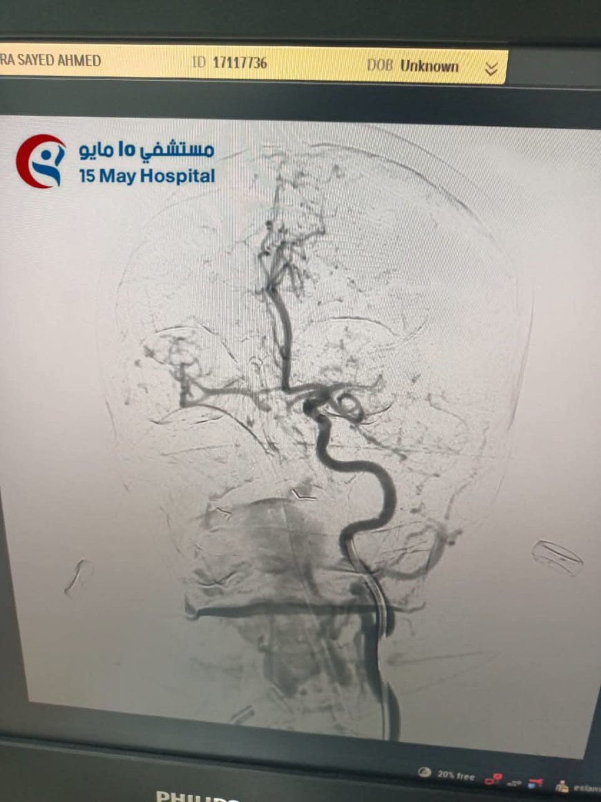 تحت مظلة أمانة المراكز الطبية المتخصصة.. إنجاز طبي جديد بمستشفى 15 مايو التخصصي يعيد الحركة لمريضة بعد جلطة حادة